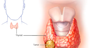 Thyroid Cancer in Bengali-থাইরয়েড ক্যান্সার কি